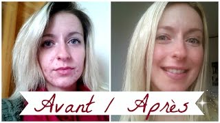 ACNE ❀ Roacutane mois après mois [upl. by Gnof]