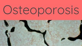 What is Osteoporosis  Pathology mini tutorials [upl. by Adnotal]