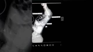 SPECIAL XRay of Invertogram Prone lateral position head down and pelvis up Dog positionquot [upl. by Carlin146]