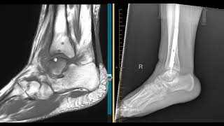 Insufficiency or stress fracture talar dome [upl. by Airaet]