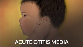 Acute Otitis Media by A Ruan J Cheng  OPENPediatrics [upl. by Palladin678]