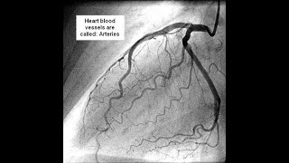 What is an Angiogram [upl. by Hild]