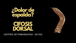 Lectura de Tomografías  ¿Dolor de espalda CIFOSIS DORSAL [upl. by Bianka945]