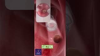 Removing Large Polyps shortmedical [upl. by Patrizio]