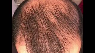 8 months using minoxidil  Rogaine 5 Before amp After results [upl. by Romelle]