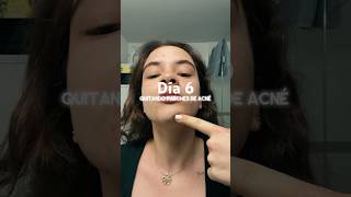 Quitando parches de acné acnepositivity acnepatch acne [upl. by Lydnek]