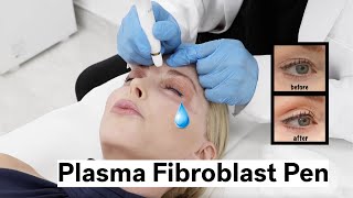 Plasma Fibroblast Pen to Treat Crepey Eyelids and Crows Feet Over 50 [upl. by Gilpin]