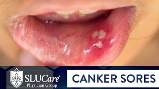 Determining Causes amp Treatment for Canker Sores  SLUCare Otolaryngology [upl. by Stanislaus]