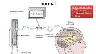 Hipertensión Endocraneana  FISIOPATOLOGIA  GRUPO ATLAS [upl. by Ettevol]