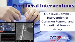 Multilevel Complex Intervention of Common Femoral and Superficial Femoral Artery [upl. by Mima]