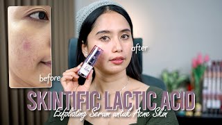 Review SKINTIFIC Lactic Acid Pemakaian 2 Minggu di Acne Prone Skin   Before After  No BUMILBUSUI [upl. by Eeralih]