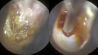 113  Fizzy amp Bubbly Ear Wax Removal using WAXscope®️ [upl. by Eadas]