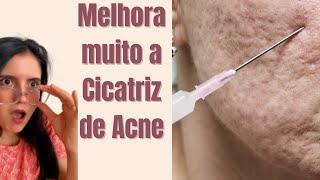 4 Tratamentos eficazes para CICATRIZ DE ACNE [upl. by Nadabus]