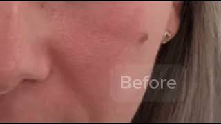 Mole Removal Surgery rejuvenceclinic91 [upl. by Onaicram]