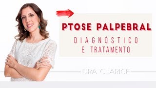 Dra Clarice Abreu  Ptose Palpebral [upl. by Grey]