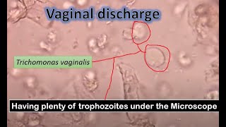 Trichomonas pus cells epithelial cells RBCs in vaginal swab microscopy [upl. by Sacks513]