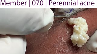 Acne Treatment Huong Da Nang 070  Perennial acne [upl. by Ogait719]