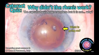 CataractCoach™ 2382 Cataract Quiz Why didnt the capsulorhexis work [upl. by Gnanmas]