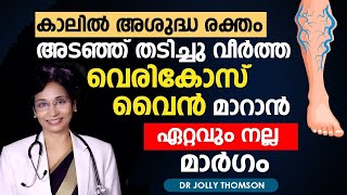 കാലിൽ അശുദ്ധ രക്തം അടഞ്ഞ് ഞരമ്പുകൾ തടിച്ചു വീർത്ത് വരുന്നുണ്ടോ  Varicose Vein  Avoid Glue Laser [upl. by Dinin]