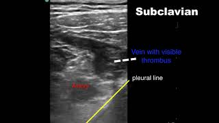 Subclavian DVT Associated with PICC Line [upl. by Eylrahc]