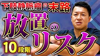 下肢静脈瘤は放っておくとどうなるの？｜放っておいても大丈夫？｜確実に進行 [upl. by Sihtnyc622]