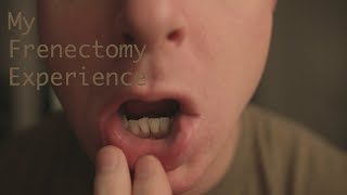 My Frenectomy Experience [upl. by Adrien567]