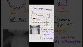 Infant Respiratory Distress Syndrome شرح حالة IRDS انشروهاللاستفادة [upl. by Louls]