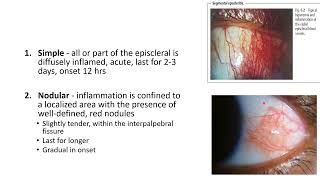 EPISCLERITIS AND SCLERITIS [upl. by Ibrik]