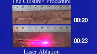 Laser Ablation vs Radiofrequency Ablation [upl. by Drawde]