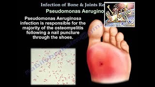 Infection of Bones amp Joints A Review  Everything You Need To Know  Dr Nabil Ebraheim [upl. by Melessa215]