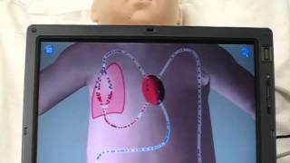 Mixed simulation of a neonate METI BabySIM with Hypoplastic Left Heart Syndrome Patent Pending [upl. by Guenevere444]