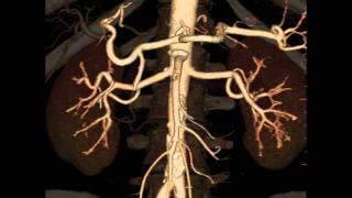 MDI Radiology  3D CT Renal Angiogram [upl. by Marquez514]