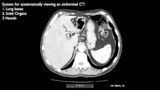 How to interpret an abdominal CT [upl. by Hashimoto451]