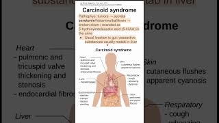 Carcinoid syndrome [upl. by Betz]