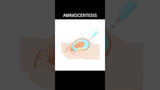 AMNIOCENTESIS amniocentesis  WHAT IS AMNIOCENTESIS shortsviraltrending [upl. by Nimra795]