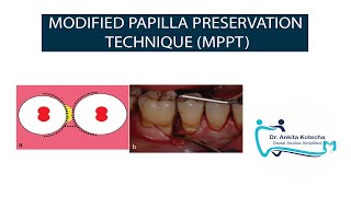 MODIFIED PAPILLA PRESERVATION TECHNIQUE MPPT MINIMALLY INVASIVE PERIODONTAL SURGERY DR ANKITA [upl. by Hsreh877]