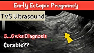 Early Ectopic Pregnancy  TVS Ultrasound  Difficult Early Diagnosis [upl. by Lundin]