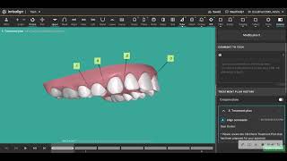 Quick Tip for Moderate Retraction of Upper Anterior Teeth with Aligners [upl. by Aratak]