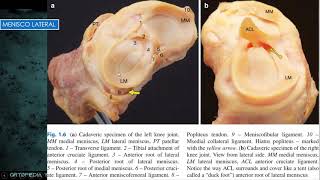 Lesiones Meniscales de Rodilla [upl. by Gervais]