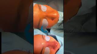 Rhinoplastie ultrasonique preservationrhinoplasty rhinoexpert [upl. by Jone782]