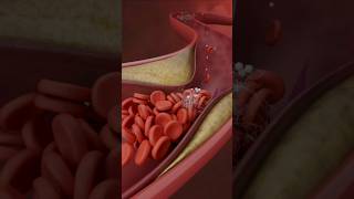 Lower Limb Angioplasty and Stenting3D Medical Animation LowerLimbStentingShorts LowerLimbviral [upl. by Gray]