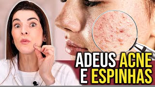 Elimine a ACNE e TODAS as ESPINHAS INFLAMADAS com essa Receita [upl. by Suiramed]