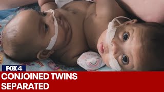 Conjoined twins separated at Cook Childrens Medical Center [upl. by Ronnica]