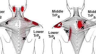 Skulder og nakke dry needling langvarig smertelindring [upl. by Kempe631]