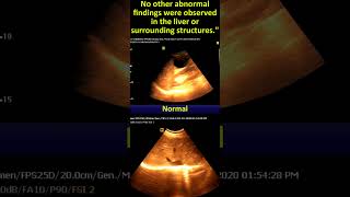 Ultrasonography of Liver Cyst Sonographic Report amp Interpretation [upl. by Charisse]