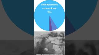 ameloblastoma [upl. by Karrie]