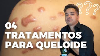 TRATAMENTOS PARA QUELOIDE  CIRURGIA PLASTICA I 4 COISAS QUE VOCÊ DEVE SABER [upl. by Gaile]