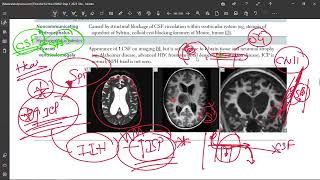 50 Idiopathic Intracranial Hypertension Pseudotumor Cerebri [upl. by Avonasac]