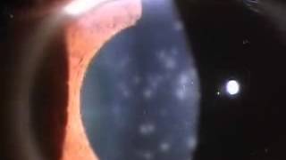 coarse punctate keratitis [upl. by Ahsir]