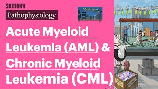 Acute Myeloid Leukemia AML amp Chronic Myeloid Leukemia CML Pathophysiology  Sketchy Medical [upl. by Hannon850]